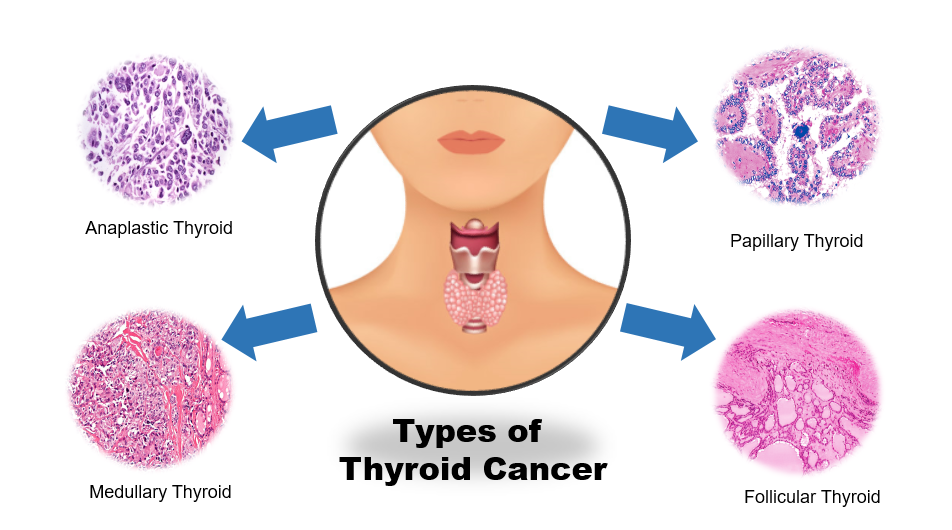 types of thyroid cancer