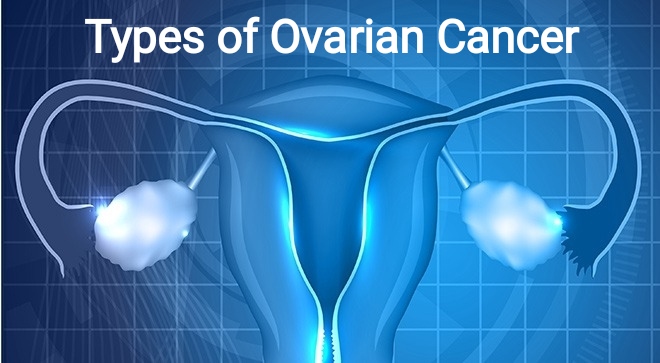 Types of ovarian cancer