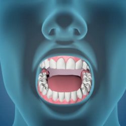 Mouth Cancer
