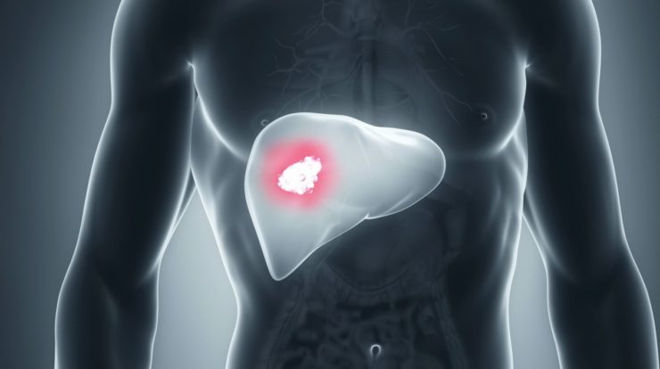 liver cancer