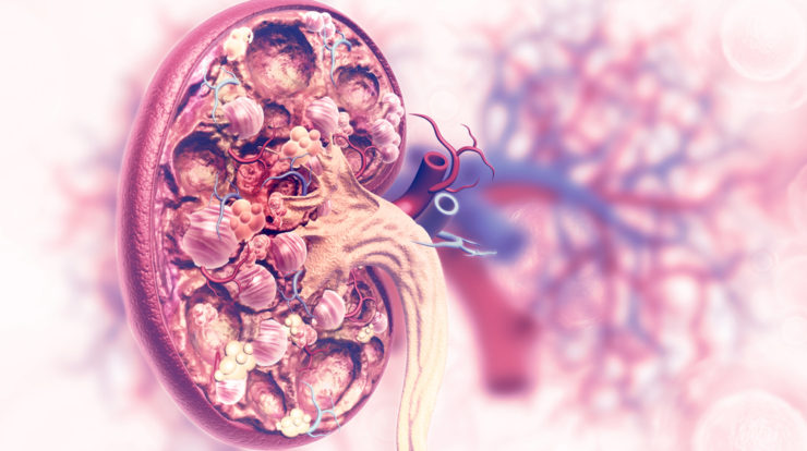 kidney cancer