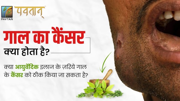 गाल के कैंसर